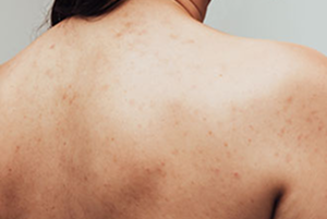 Post Herpetic Neuralgia Treatment in Gurugram